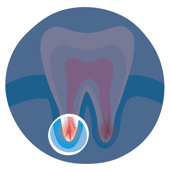 What is a Root Canal? GentleWave Procedure